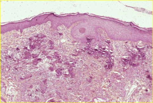 Un cas de calcinose cutanee associee a un syndrome de cushing iatrogene et traitee a la colchicine