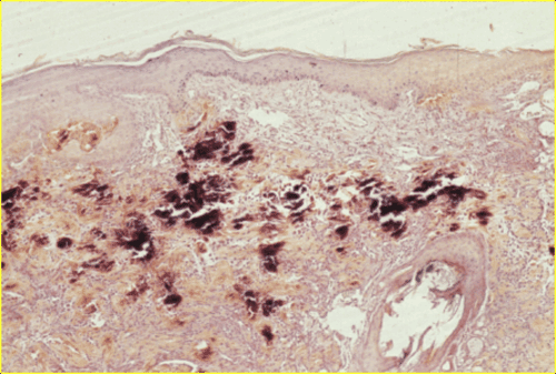 Un cas de calcinose cutanee associee a un syndrome de cushing iatrogene et traitee a la colchicine