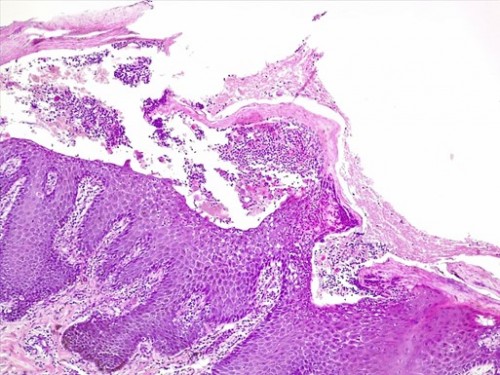 Dermatoses auto-immunes