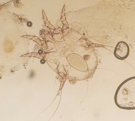 Dermatoses parasitaires