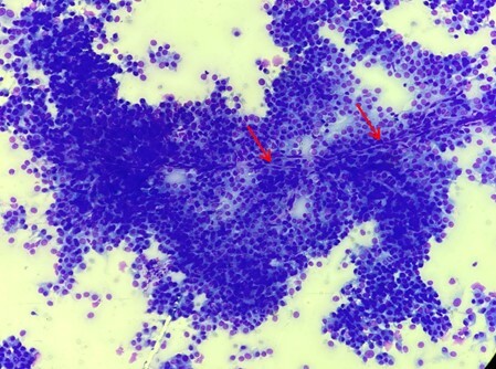 Un cas de tumeur des gaines vasculaires de grade I.