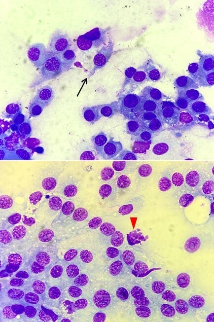 Un cas de tumeur des gaines vasculaires de grade I.