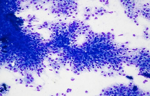 Un cas de xanthogranulome chez un Bullmastiff
