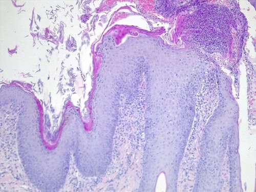 Discussion à propos d’un cas de dermatite lichénoïde psoriasiforme atypique chez une chienne Fox-Terrier.