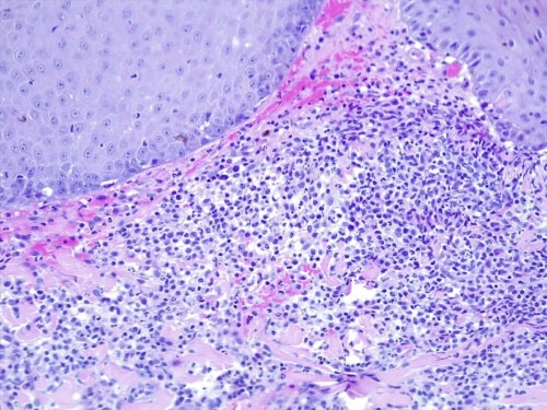 Discussion à propos d’un cas de dermatite lichénoïde psoriasiforme atypique chez une chienne Fox-Terrier.