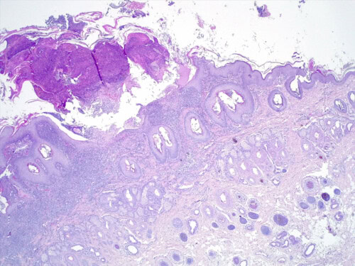 Discussion à propos d’un cas de dermatite lichénoïde psoriasiforme atypique chez une chienne Fox-Terrier.