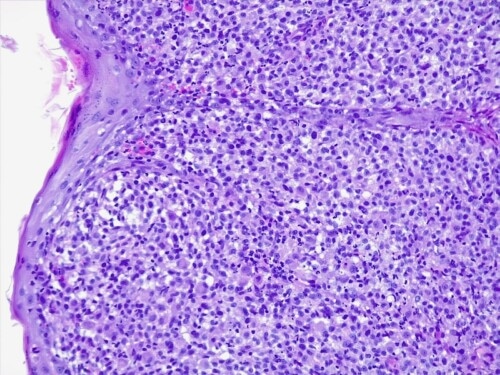 A propos d’un cas d’histiocytose progressive féline