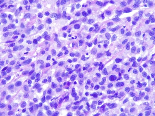A propos d’un cas d’histiocytose progressive féline