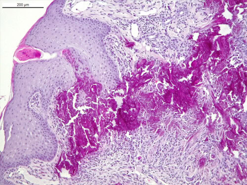 Un cas de calcinose cutanee associee a un syndrome de cushing iatrogene et traitee a la colchicine