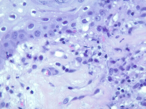 Un cas de lupus cutané nasal canin Un cas de lupus cutané nasal canin