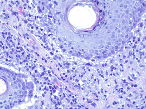 Un cas de lupus cutané nasal canin Un cas de lupus cutané nasal canin