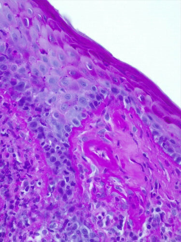 Un cas de lupus cutané nasal canin Un cas de lupus cutané nasal canin