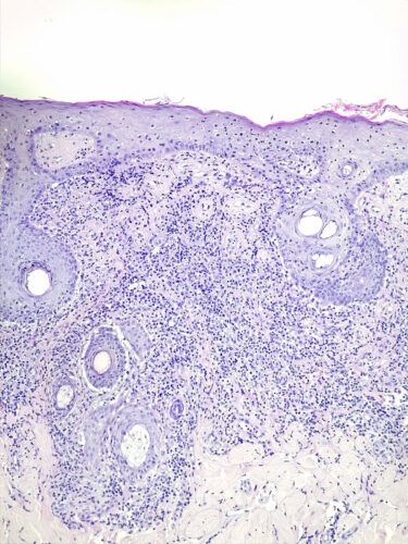 Un cas de lupus cutané nasal canin Un cas de lupus cutané nasal canin