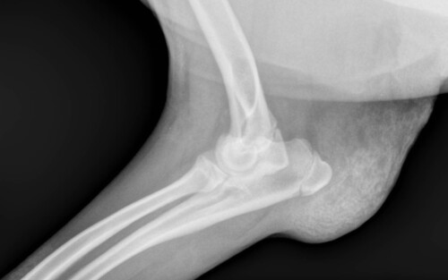Un cas de calcinose cutanee associee a un syndrome de cushing iatrogene et traitee a la colchicine