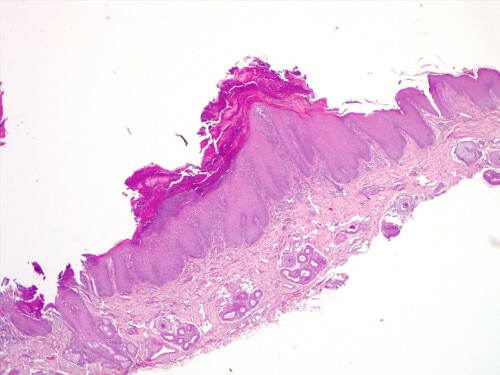 Un cas de dermatose lichénoïde idiopathique canine