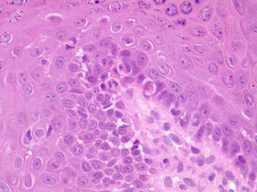 Un cas de dermatose lichénoïde idiopathique canine
