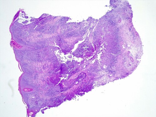 Un cas d’osteoma cutis chez un terrier