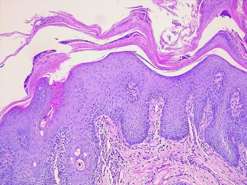 Un cas de dermatose répondant au zinc chez un Husky