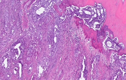 Un cas atypique de metastases digitees de tumeur pulmonaire chez un chat Tissu biologiques en microscopie colorée montrant des structures cellulaires et vasculaires en nuances de violet, rose, et blanc.