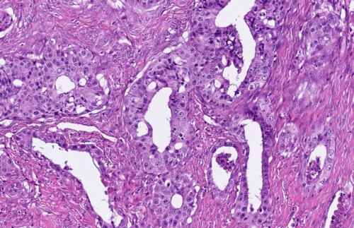 Un cas atypique de metastases digitees de tumeur pulmonaire chez un chat Tissu biologique comprimé visualisé au microscope avec des structures glandulaires et des cellules épithéliales en coloration H&E.