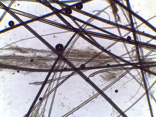 adenite-sebacee-granulomateuse10