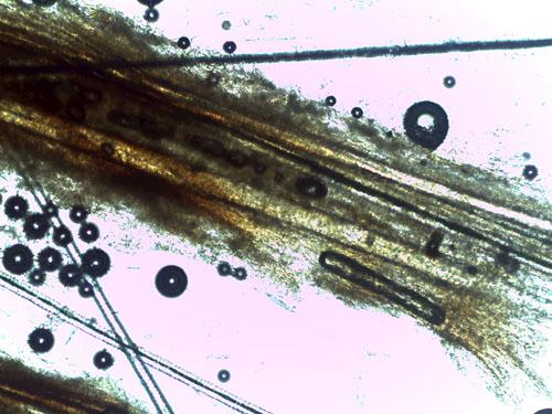 adenite-sebacee-granulomateuse6