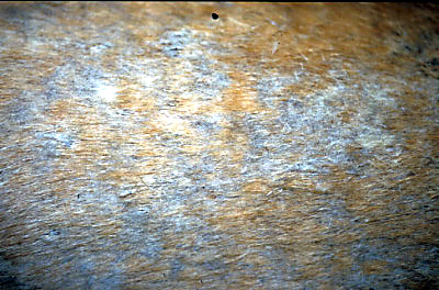 adenite-sebacee-repondant-a-ciclosporine2