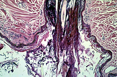adenite-sebacee-repondant-a-ciclosporine6
