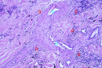 Un cas d'artérite du philtrum nasal Un cas d'artérite du philtrum nasal