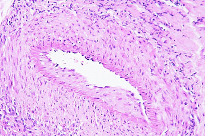 Un cas d'artérite du philtrum nasal Un cas d'artérite du philtrum nasal