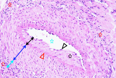 Un cas d'artérite du philtrum nasal Un cas d'artérite du philtrum nasal