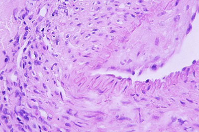 Un cas d'artérite du philtrum nasal Un cas d'artérite du philtrum nasal