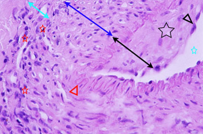 Un cas d'artérite du philtrum nasal Un cas d'artérite du philtrum nasal
