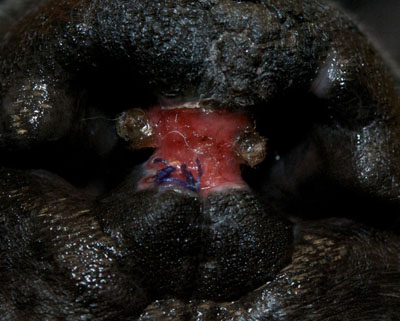 Un cas d'artérite du philtrum nasal Un cas d'artérite du philtrum nasal