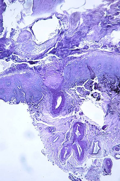 Un cas d'artérite du philtrum nasal Un cas d'artérite du philtrum nasal