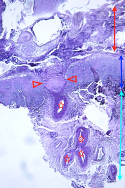 Un cas d'artérite du philtrum nasal Un cas d'artérite du philtrum nasal