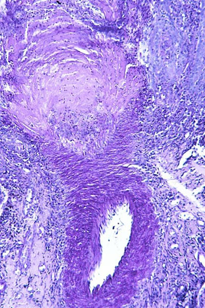 Un cas d'artérite du philtrum nasal Un cas d'artérite du philtrum nasal