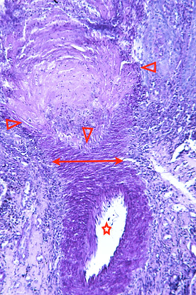 Un cas d'artérite du philtrum nasal Un cas d'artérite du philtrum nasal