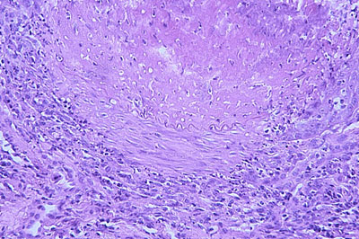 Un cas d'artérite du philtrum nasal Un cas d'artérite du philtrum nasal