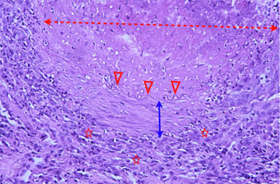 Un cas d'artérite du philtrum nasal Un cas d'artérite du philtrum nasal