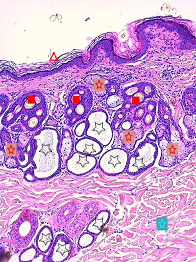 Un cas de démodécie pauci-parasitaire