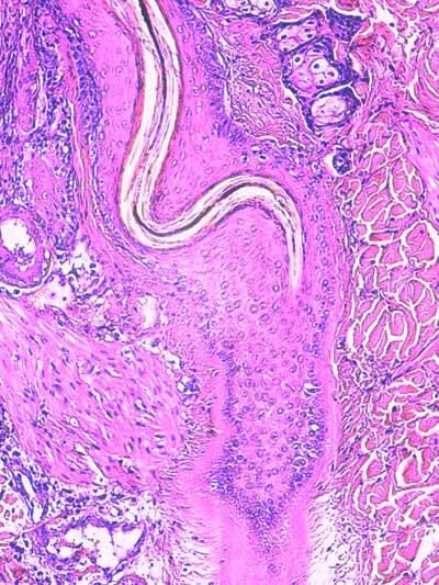 Un cas de dermo-hypodermite bactérienne nécrosante profonde à germe Gram négatif après un toilettage par épilation