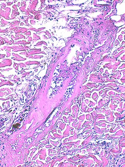 Un cas de dermo-hypodermite bactérienne nécrosante profonde à germe Gram négatif après un toilettage par épilation