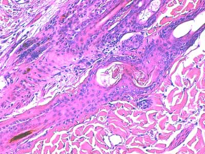 Un cas de dermo-hypodermite bactérienne nécrosante profonde à germe Gram négatif après un toilettage par épilation