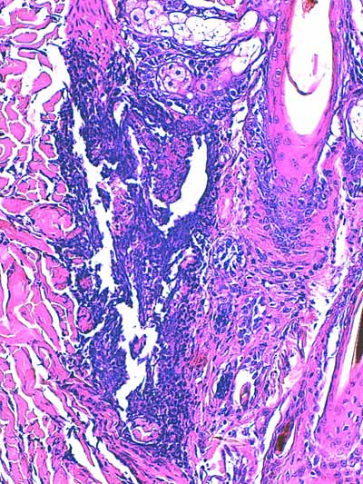 Un cas de dermo-hypodermite bactérienne nécrosante profonde à germe Gram négatif après un toilettage par épilation