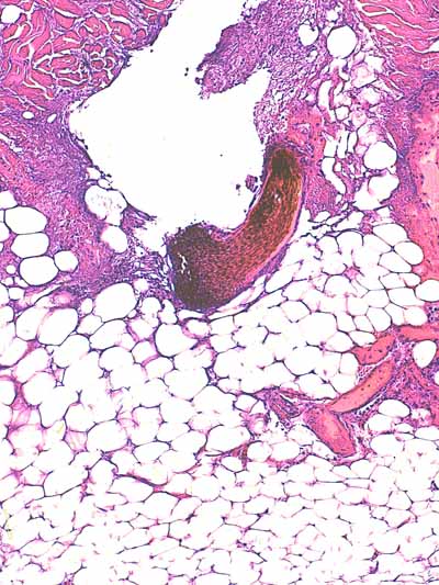 Un cas de dermo-hypodermite bactérienne nécrosante profonde à germe Gram négatif après un toilettage par épilation