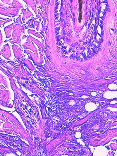 Un cas de dermo-hypodermite bactérienne nécrosante profonde à germe Gram négatif après un toilettage par épilation