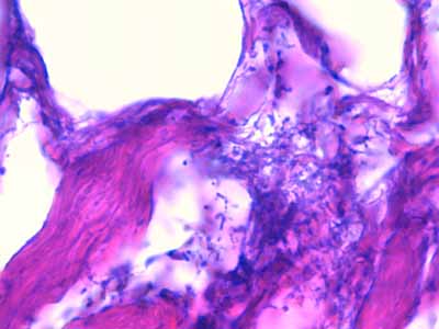 Un cas de dermo-hypodermite bactérienne nécrosante profonde à germe Gram négatif après un toilettage par épilation