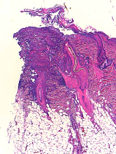 Un cas de dermo-hypodermite bactérienne nécrosante profonde à germe Gram négatif après un toilettage par épilation