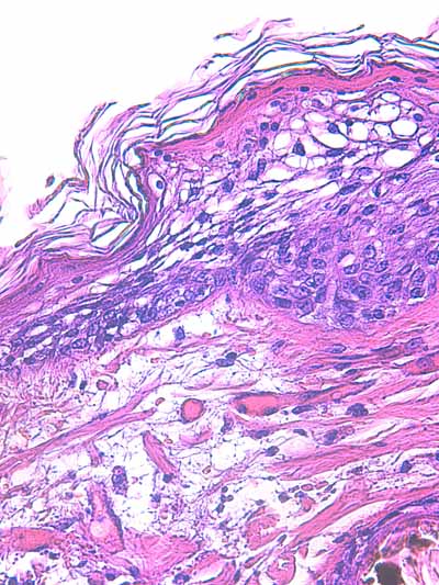Un cas de dermo-hypodermite bactérienne nécrosante profonde à germe Gram négatif après un toilettage par épilation